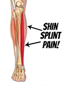Shin-Splints-1